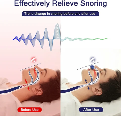 Oak & Coral | Micro CPAP Anti-Snoring Device | Maskless Sleep Apnea Treatment